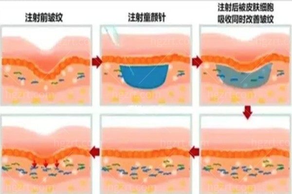 想提前了解下现在国内合法的童颜针有哪些？