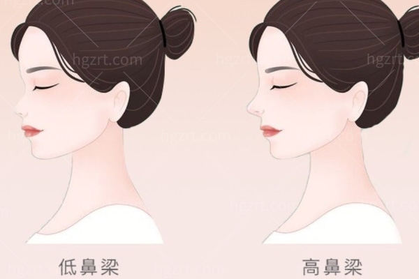 哪些鼻子适合做耳软骨隆鼻