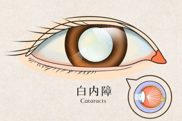 白内障人工晶体四大品牌价格表