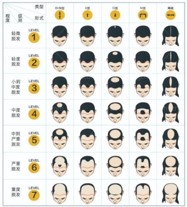 脱发等级对照图