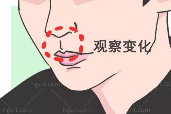 北京清木医疗美容医院人中缩短怎么样