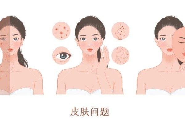 正在哺乳期，想问下宝妈哺乳期能做光子嫩肤吗？