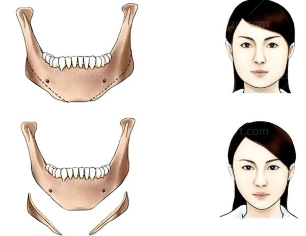 北京做下颌角磨骨多少钱