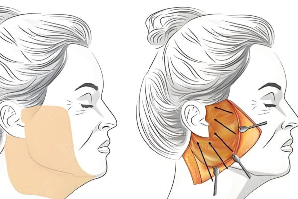 谢宏彬拉皮手术价格多少钱一次?坐诊北京奥尔贝德拉皮除皱技术可靠口碑好