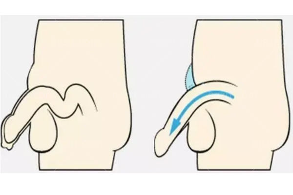 龟头注射增大到底靠不靠谱