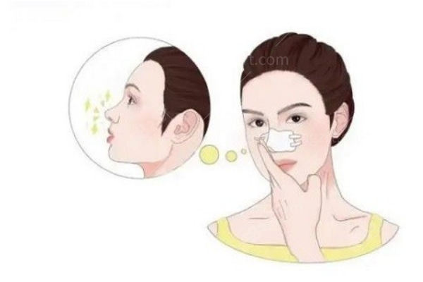 成都西区医院邓东伟做鼻子怎么样?擅长高难度鼻修复微创自然无假体感