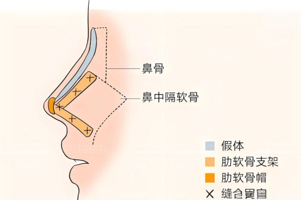 成都西区医院邓东伟做鼻子怎么样?擅长高难度鼻修复微创自然无假体感