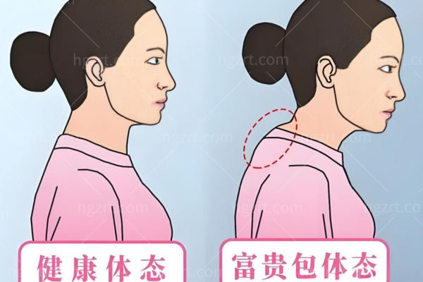 重庆哪家医院可以做富贵包手术?华美/军美/星荣/时光做富贵包微创技术强劲不踩雷