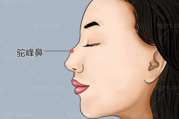 重庆铜雀台周柯做肋骨鼻技术到底牛在哪儿