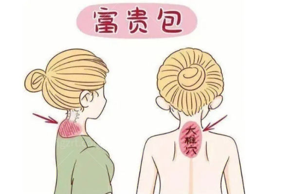 大连微创治疗富贵包哪家好