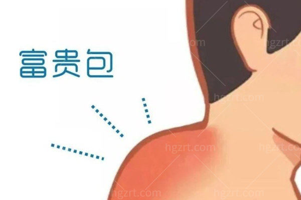 大连微创治疗富贵包哪家技术正规