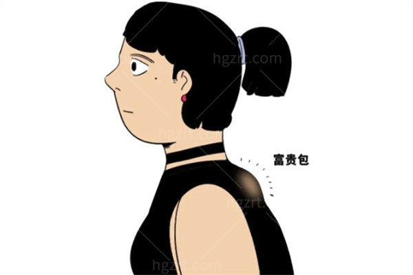 大连微创治疗富贵包哪家技术靠谱