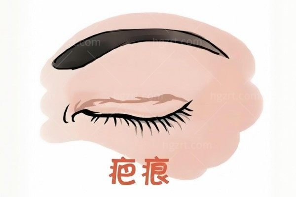 2025修复双眼皮的十大医生 刘志刚/杜园园/魏志香/张冰洁/师丽丽修复双眼皮排名靠前