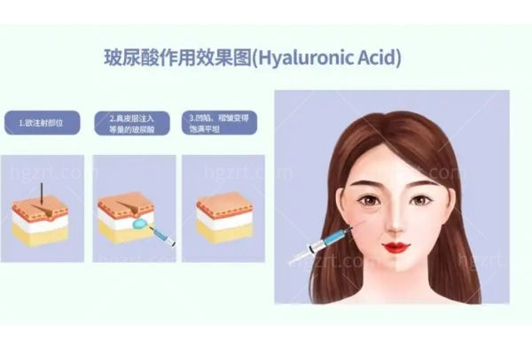 医美常用的玻尿酸排名榜 瑞蓝/艾莉薇/伊婉/润百颜/海薇/乔雅登玻尿酸排名