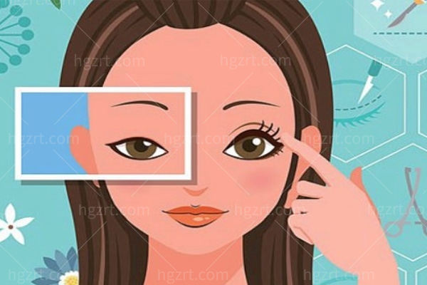 广州美莱陈贵宗双眼皮好吗?初眼/眼修复技术牛术后妈生感