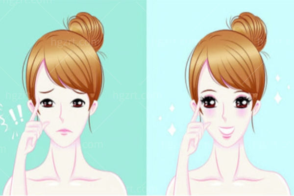 广州美莱陈贵宗双眼皮技术怎么样