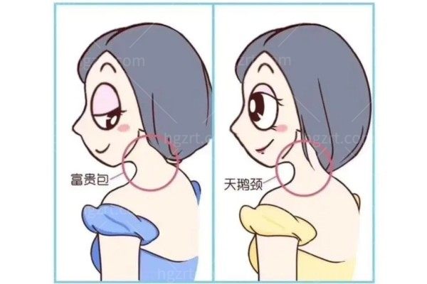 准备做富贵包手术,富贵包手术怎么选,需要注意什么?