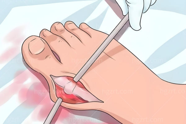 苏敬达和温建民谁腻害?从切口/复原/长期稳定性来看解决拇外翻困扰