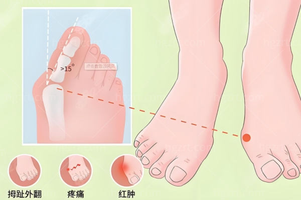 广州拇外翻微创手术医院排名 广州广大做拇外翻技术损伤小复原快