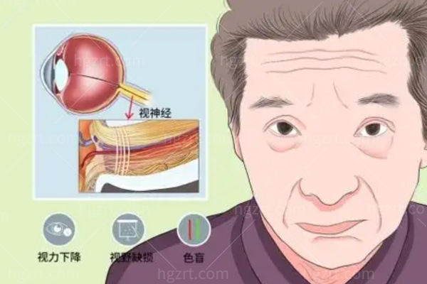 视神经减压手术危险吗?早发现早治疗危险能降低黄金手术时间是72h