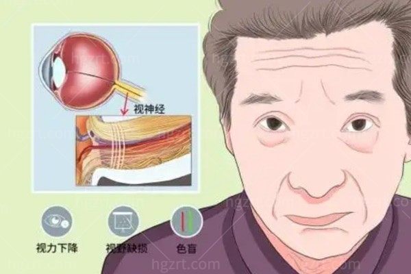 视神经减压术是大手术吗？
