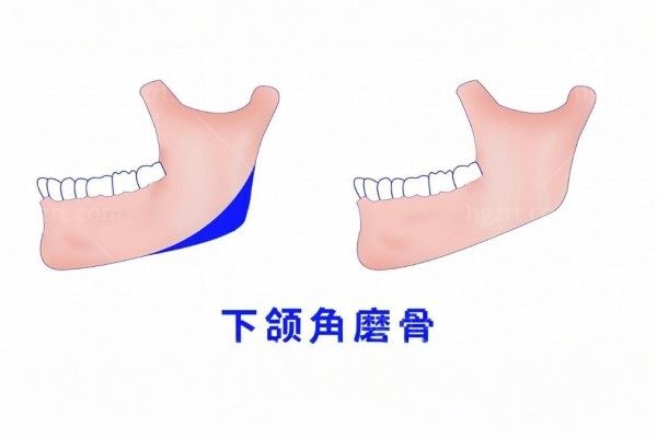 广州削骨出名的医生排名前10 做削骨技术可靠实力派选手是这几位