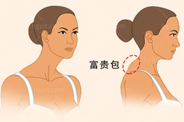 富贵包手术价格一览表