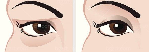 眼底眶隔释放术多少钱