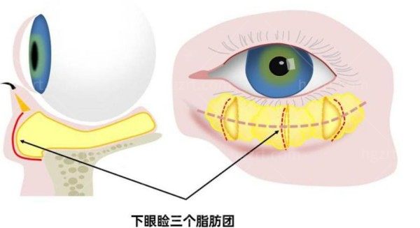 眼底眶隔释放术价格表