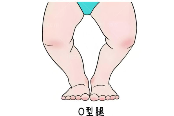 李沁奕腿部矫正手术怎么样
