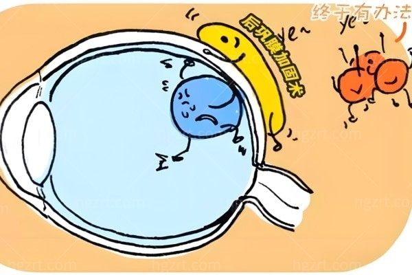 深度揭秘速看:封康和王乐今谁更腻害?后巩膜加固术选谁更长久有效?