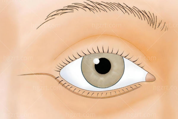 国内修复下眼皮外翻谁更好?杜园园/张冰洁/刘志刚/魏志香技术惊爆！