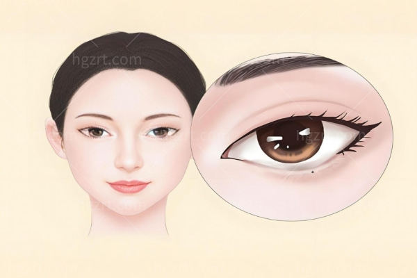 国内修复下眼皮外翻谁更好?杜园园/张冰洁/刘志刚/魏志香技术惊爆！