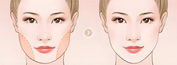 张笑天颧骨高磨骨手术需要多少钱