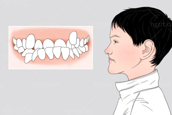 肖林正颌手术排队多长时间?做正颌3D导航价格透明且性价比高可预约