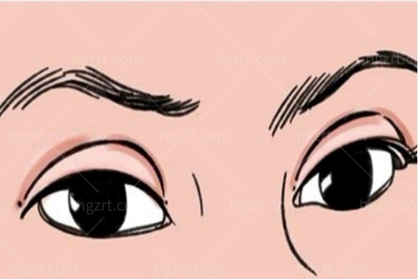 重庆哪里割双眼皮好