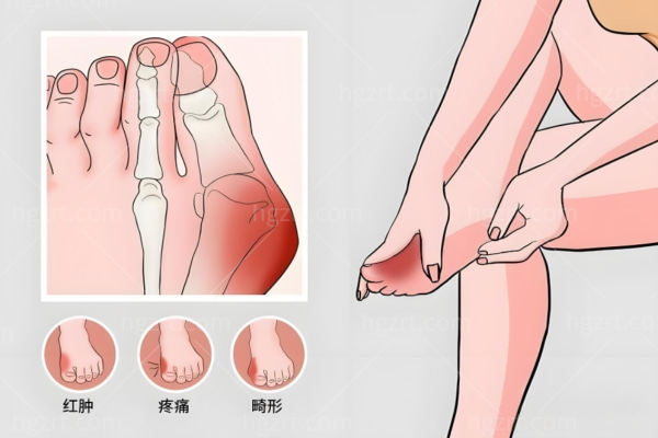 深圳做拇指外翻手术哪家医院好?深圳拇外翻整形好医院排名