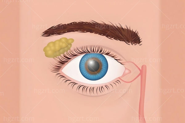 睑板腺囊肿是怎么引起的?能自愈吗?不手术有什么后果?手术多少钱?