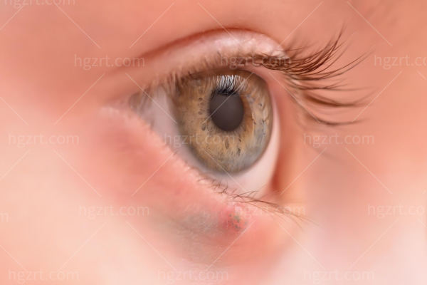 睑板腺囊肿是怎么引起的?能自愈吗?不手术有什么后果?手术多少钱?