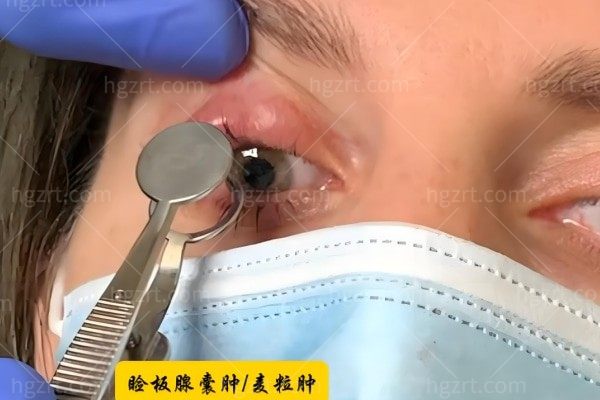 想了解一下：眼睑囊肿拖久了会癌变吗？