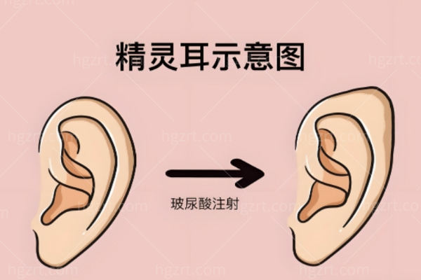 埋线精灵耳怎么做的