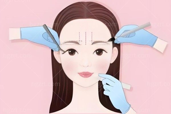 美杜莎双眼皮和park双眼皮哪个好?从手术原理/缝合方式/适应人群来深度解析