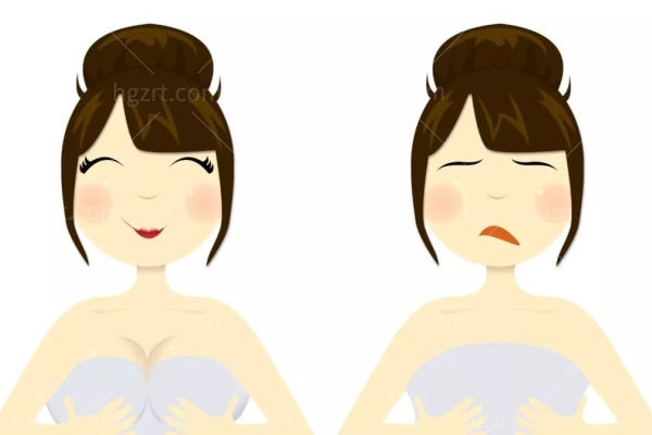 人工韧带乳房上提术复原后对比图片:位置明显上提/形态饱满自然/乳晕同步缩小