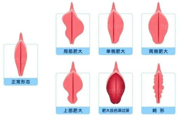 八爪鱼紧缩术最简单三个动作:基础收缩/分段提升/爆发训练安适省事易坚持
