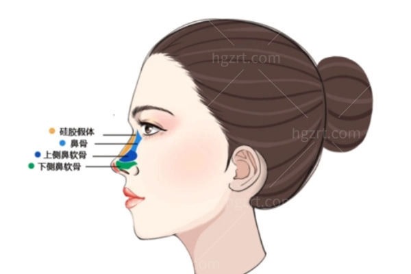 隆鼻材料有哪几种分类?自体软骨/自体脂肪/硅胶假体/膨体/玻尿酸深度解析