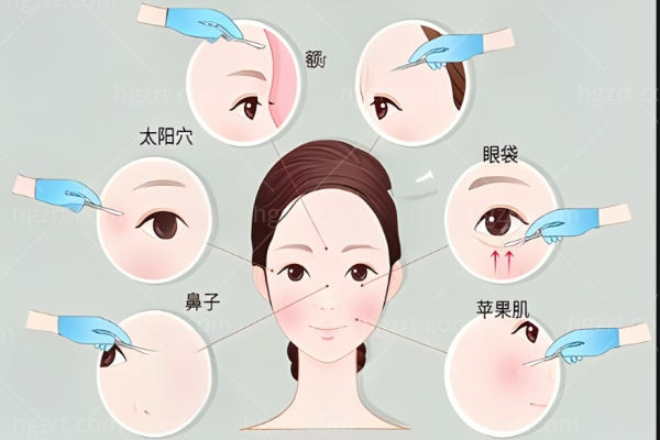 面部填充奥美定能取出来吗