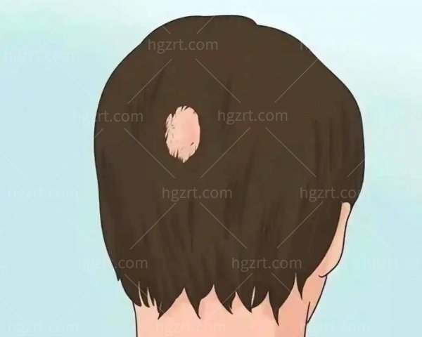 斑秃是什么原因造成的