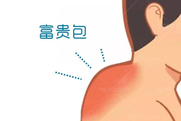2025年做富贵包手术多少钱