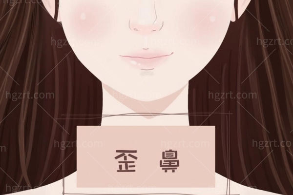 歪鼻矫正要多少钱?歪鼻矫正风险不大6-12个月就能复原有效改善歪鼻