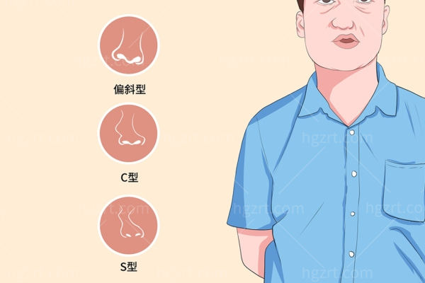 歪鼻矫正要多少钱?歪鼻矫正风险不大6-12个月就能复原有效改善歪鼻